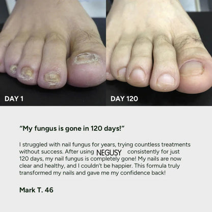 Nail Fungus Treatment Gel Limited Time 80%OFF 🔥