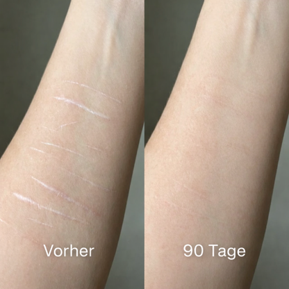 ODALIT™ Silikon-Narbenstick – Zeitlich begrenztes Angebot: 75 % Rabatt | 1+1 gratis🔥Letzter Tag⏰