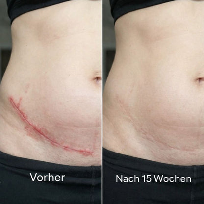 ODALIT™ Silikon-Narbenstick – Zeitlich begrenztes Angebot: 75 % Rabatt | 1+1 gratis🔥Letzter Tag⏰