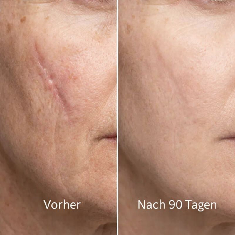 ODALIT™ Silikon-Narbenstick – Zeitlich begrenztes Angebot: 75 % Rabatt | 1+1 gratis🔥Letzter Tag⏰