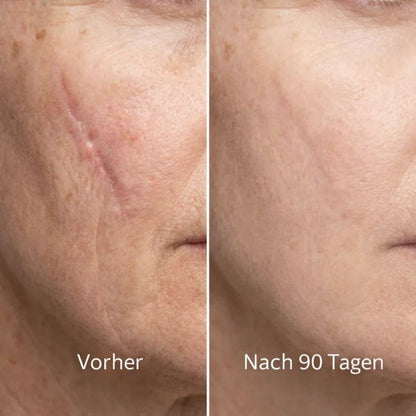 ODALIT™ Silikon-Narbenstick – Zeitlich begrenztes Angebot: 75 % Rabatt | 1+1 gratis🔥Letzter Tag⏰