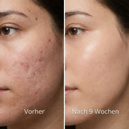 ODALIT™ Silikon-Narbenstick – Zeitlich begrenztes Angebot: 75 % Rabatt | 1+1 gratis🔥Letzter Tag⏰