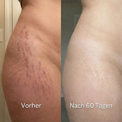 ODALIT™ Silikon-Narbenstick – Zeitlich begrenztes Angebot: 75 % Rabatt | 1+1 gratis🔥Letzter Tag⏰